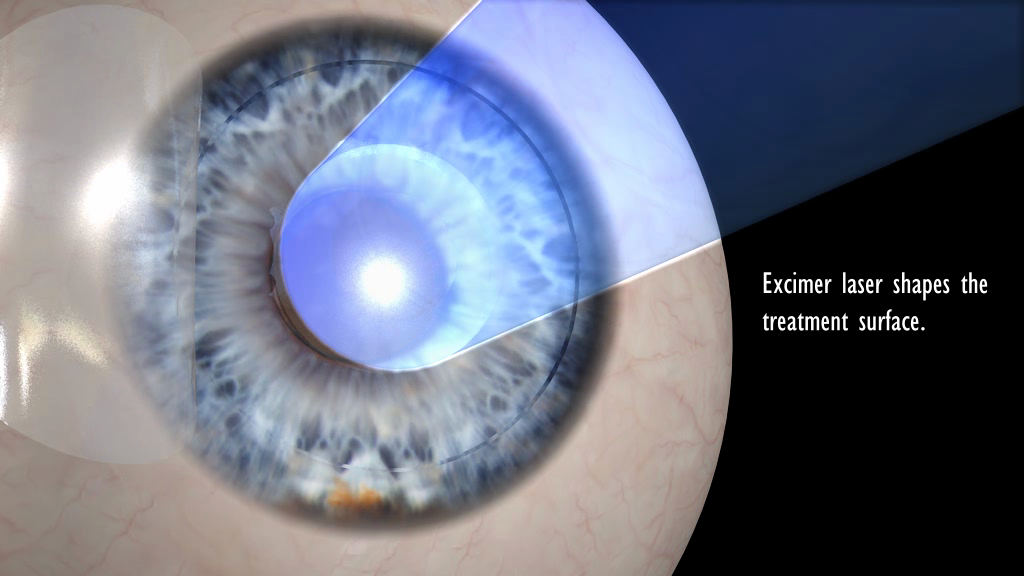 diagram of an eyeball undergoing LASIK treatment